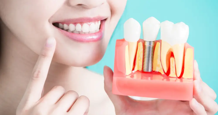 Revitalize Your Smile With Dental Implants